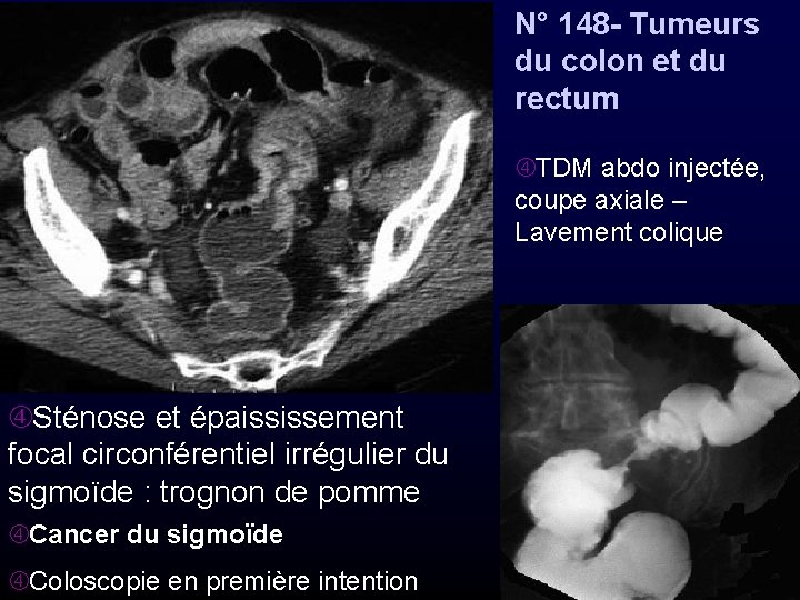 N° 148 - Tumeurs du colon et du rectum TDM abdo injectée, coupe axiale