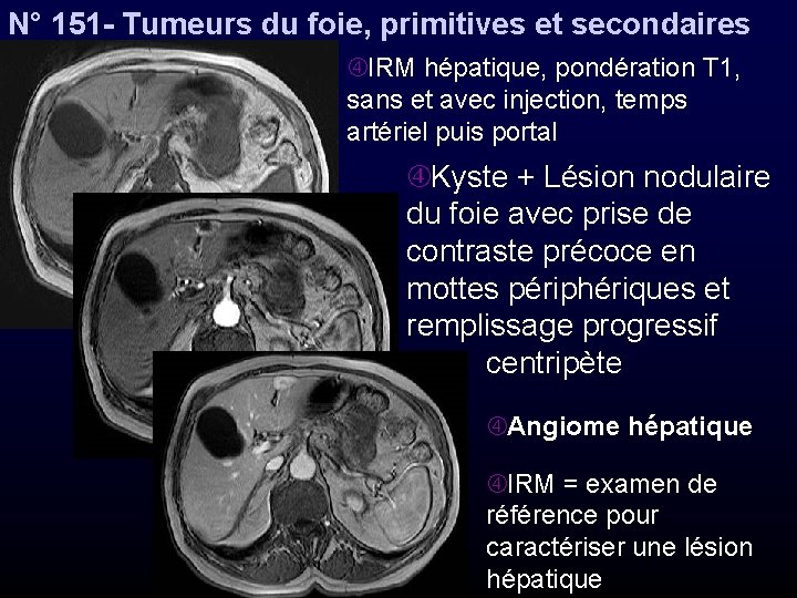 N° 151 - Tumeurs du foie, primitives et secondaires IRM hépatique, pondération T 1,