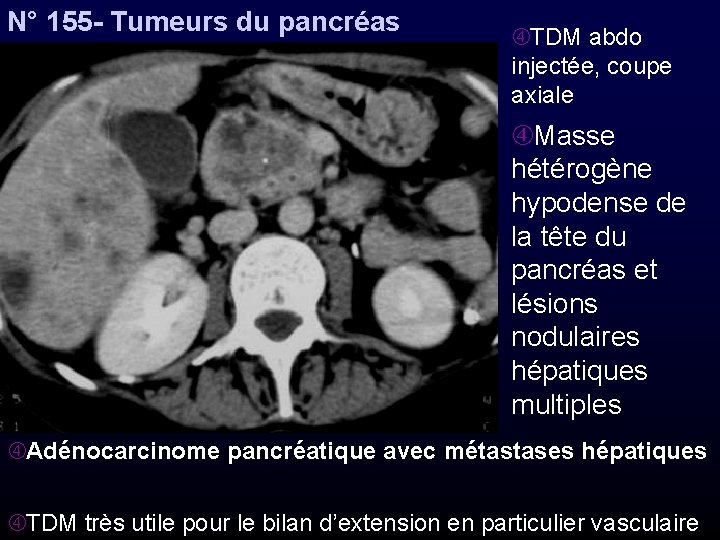 N° 155 - Tumeurs du pancréas TDM abdo injectée, coupe axiale Masse hétérogène hypodense