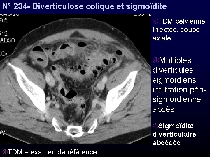 N° 234 - Diverticulose colique et sigmoïdite TDM pelvienne injectée, coupe axiale Multiples diverticules