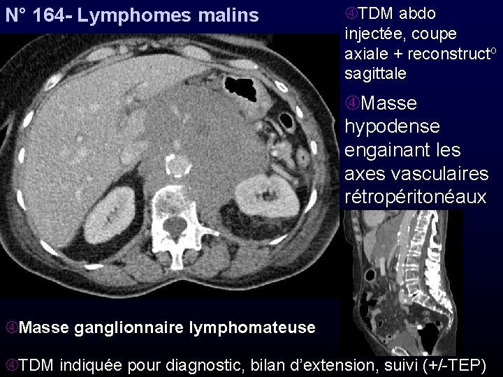 N° 164 - Lymphomes malins TDM abdo injectée, coupe axiale + reconstructo sagittale Masse