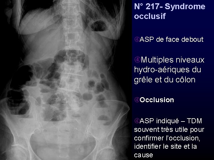 N° 217 - Syndrome occlusif ASP de face debout Multiples niveaux hydro-aériques du grêle