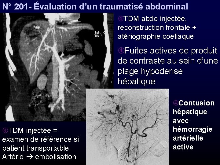 N° 201 - Évaluation d’un traumatisé abdominal TDM abdo injectée, reconstruction frontale + atériographie