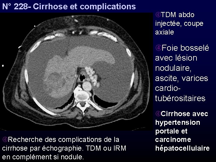 N° 228 - Cirrhose et complications TDM abdo injectée, coupe axiale Foie bosselé avec