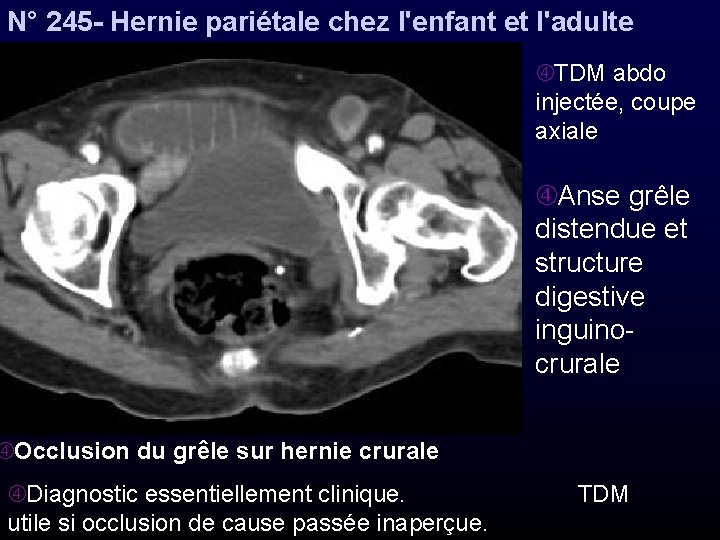 N° 245 - Hernie pariétale chez l'enfant et l'adulte TDM abdo injectée, coupe axiale