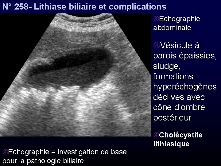 N° 258 - Lithiase biliaire et complications Echographie abdominale Vésicule à parois épaissies, sludge,