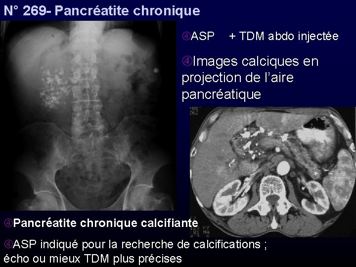 N° 269 - Pancréatite chronique ASP + TDM abdo injectée Images calciques en projection