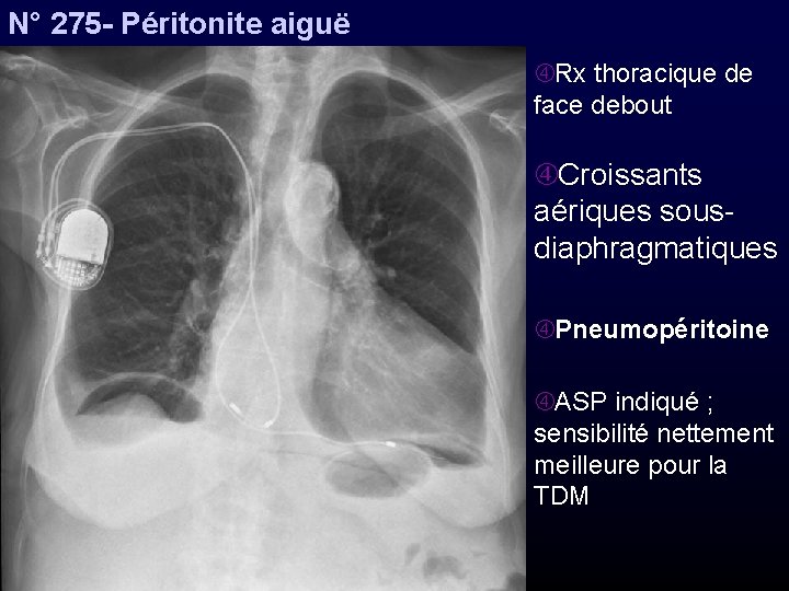 N° 275 - Péritonite aiguë Rx thoracique de face debout Croissants aériques sousdiaphragmatiques Pneumopéritoine