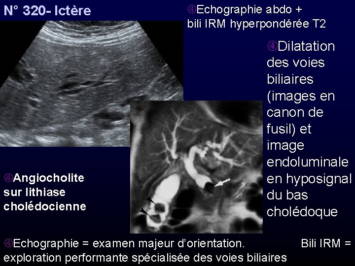 N° 320 - Ictère Angiocholite sur lithiase cholédocienne Echographie abdo + bili IRM hyperpondérée