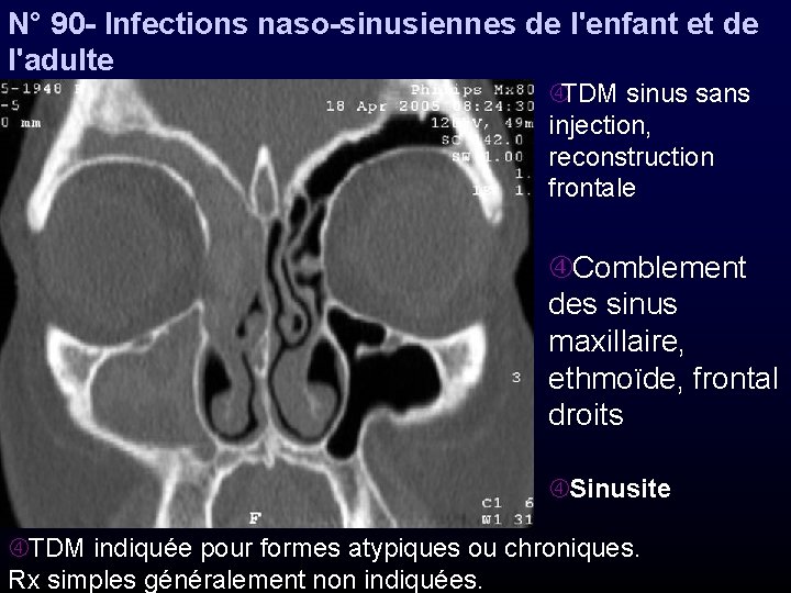 N° 90 - Infections naso-sinusiennes de l'enfant et de l'adulte TDM sinus sans injection,