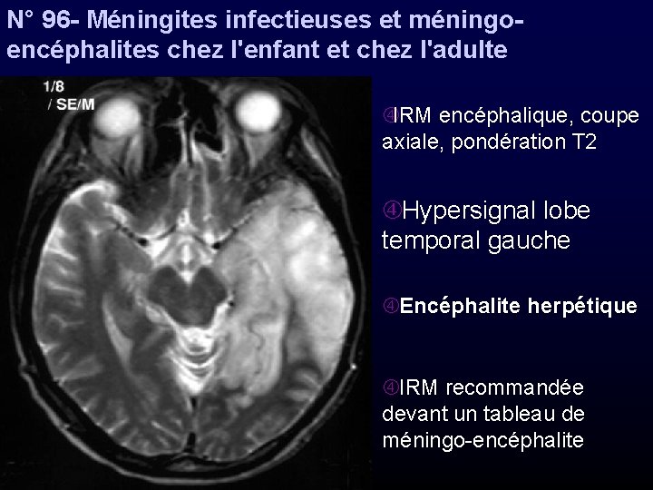 N° 96 - Méningites infectieuses et méningoencéphalites chez l'enfant et chez l'adulte IRM encéphalique,