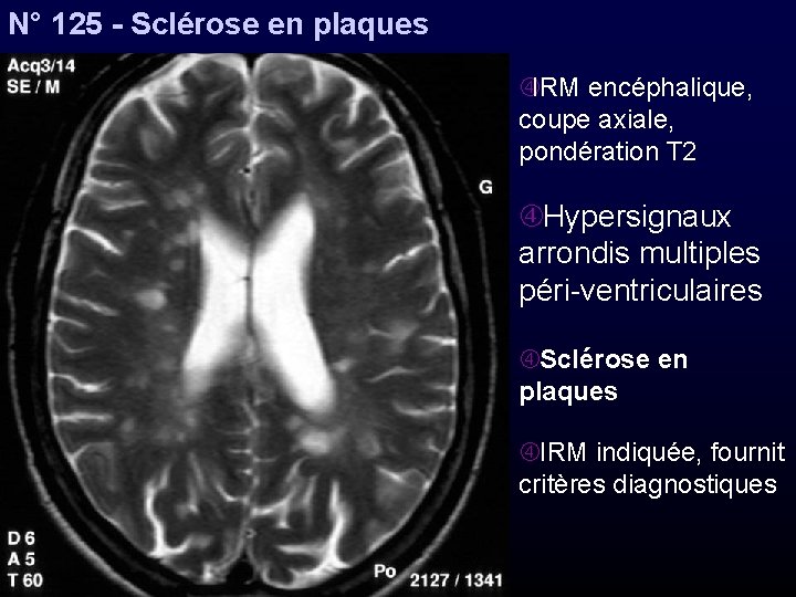 N° 125 - Sclérose en plaques IRM encéphalique, coupe axiale, pondération T 2 Hypersignaux