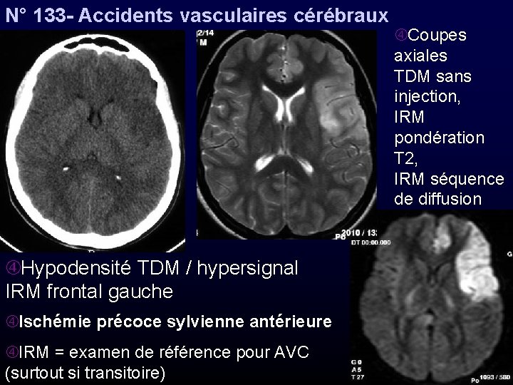 N° 133 - Accidents vasculaires cérébraux Coupes axiales TDM sans injection, IRM pondération T