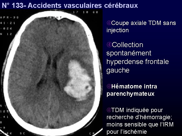 N° 133 - Accidents vasculaires cérébraux Coupe axiale TDM sans injection Collection spontanément hyperdense