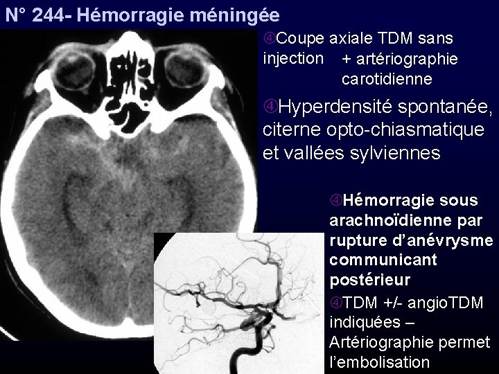 N° 244 - Hémorragie méningée Coupe axiale TDM sans injection + artériographie carotidienne Hyperdensité