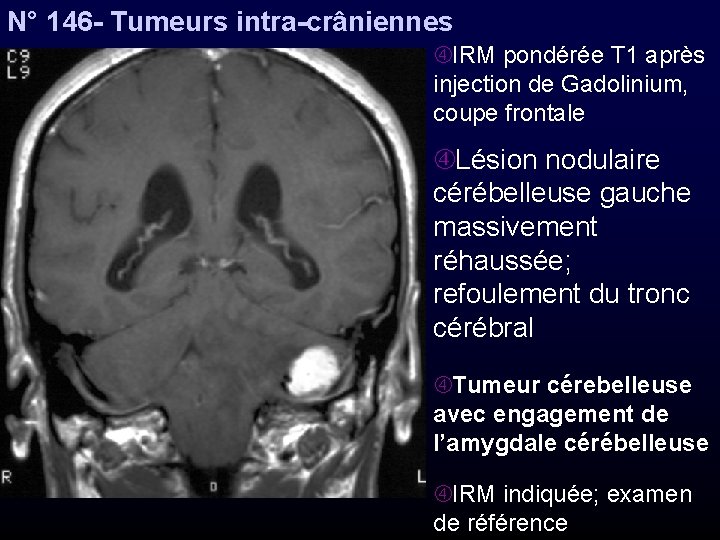 N° 146 - Tumeurs intra-crâniennes IRM pondérée T 1 après injection de Gadolinium, coupe