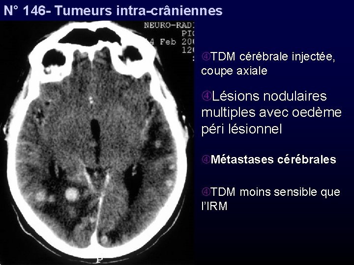 N° 146 - Tumeurs intra-crâniennes TDM cérébrale injectée, coupe axiale Lésions nodulaires multiples avec