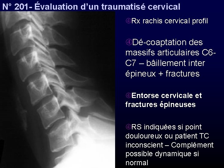 N° 201 - Évaluation d’un traumatisé cervical Rx rachis cervical profil Dé-coaptation des massifs