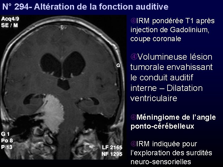 N° 294 - Altération de la fonction auditive IRM pondérée T 1 après injection