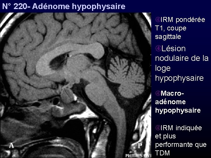 N° 220 - Adénome hypophysaire IRM pondérée T 1, coupe sagittale Lésion nodulaire de