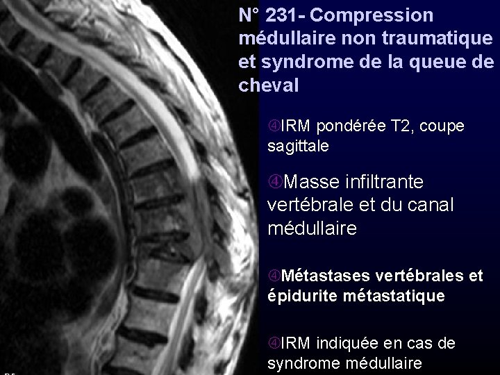 N° 231 - Compression médullaire non traumatique et syndrome de la queue de cheval