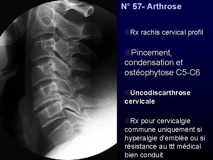 N° 57 - Arthrose Rx rachis cervical profil Pincement, condensation et ostéophytose C 5