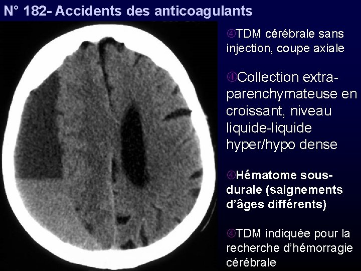 N° 182 - Accidents des anticoagulants TDM cérébrale sans injection, coupe axiale Collection extraparenchymateuse
