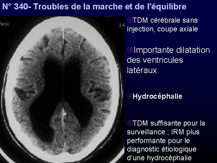 N° 340 - Troubles de la marche et de l'équilibre TDM cérébrale sans injection,