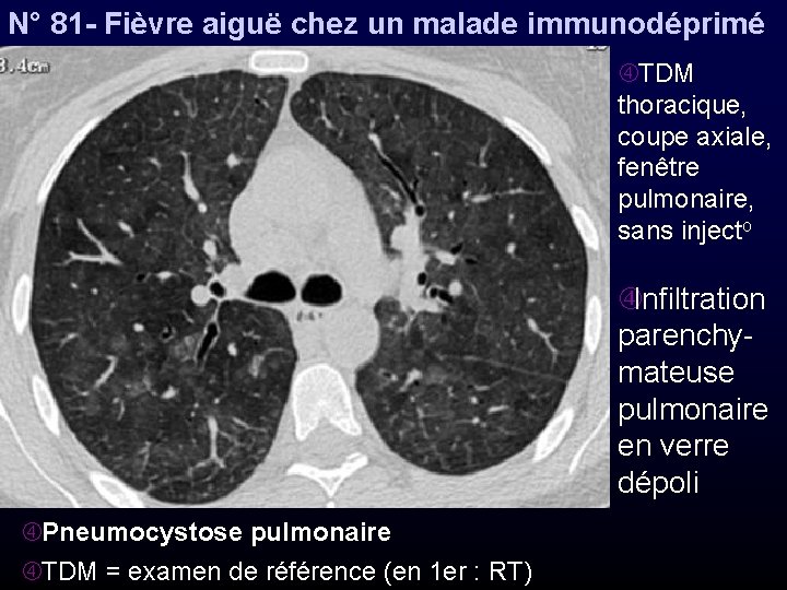 N° 81 - Fièvre aiguë chez un malade immunodéprimé TDM thoracique, coupe axiale, fenêtre