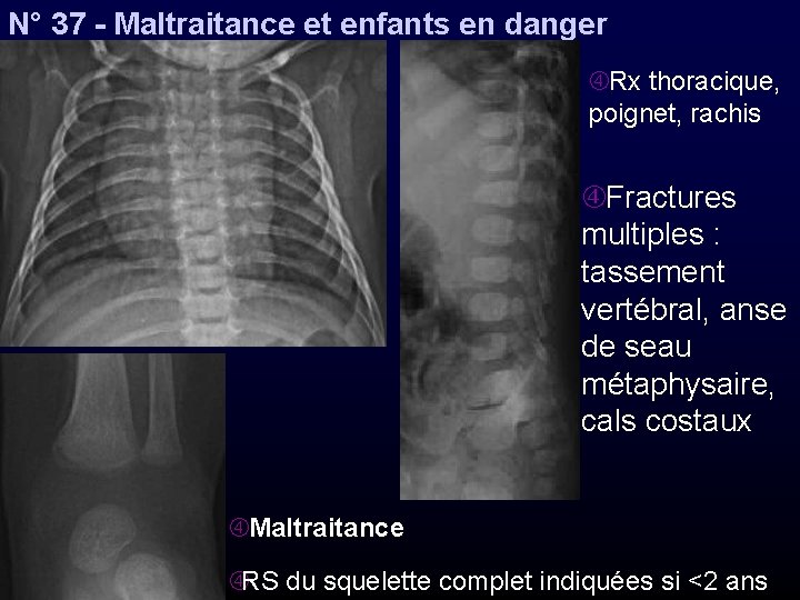 N° 37 - Maltraitance et enfants en danger Rx thoracique, poignet, rachis Fractures multiples