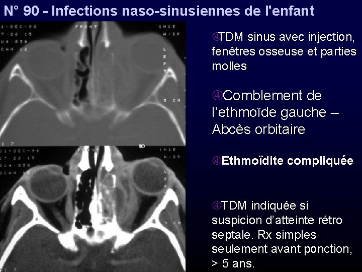 N° 90 - Infections naso-sinusiennes de l'enfant TDM sinus avec injection, fenêtres osseuse et