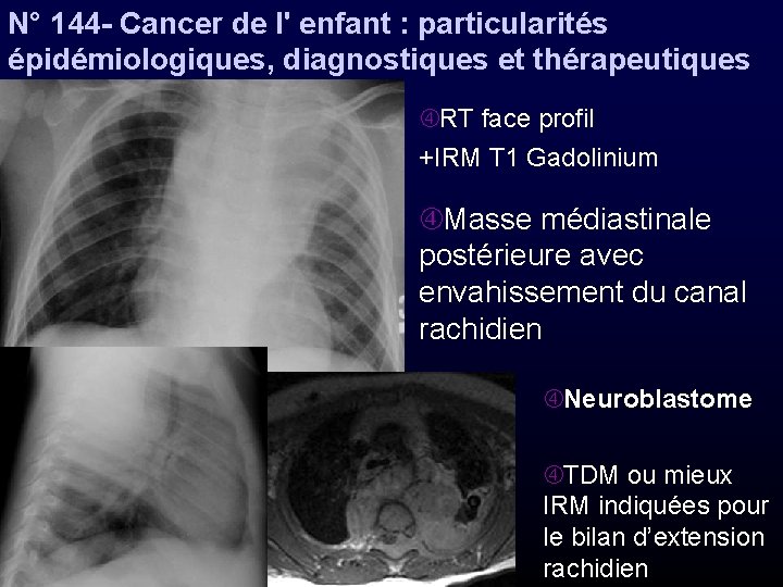 N° 144 - Cancer de l' enfant : particularités épidémiologiques, diagnostiques et thérapeutiques RT