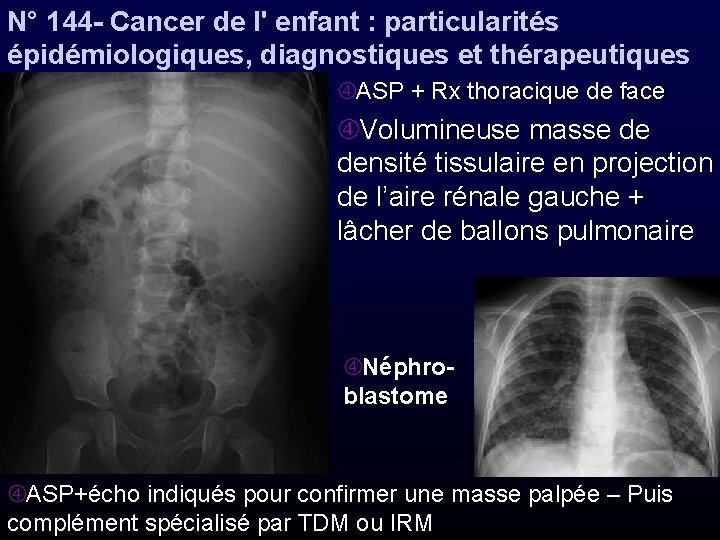 N° 144 - Cancer de l' enfant : particularités épidémiologiques, diagnostiques et thérapeutiques ASP