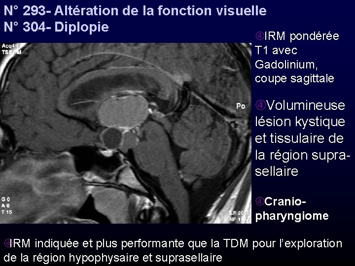 N° 293 - Altération de la fonction visuelle N° 304 - Diplopie IRM pondérée