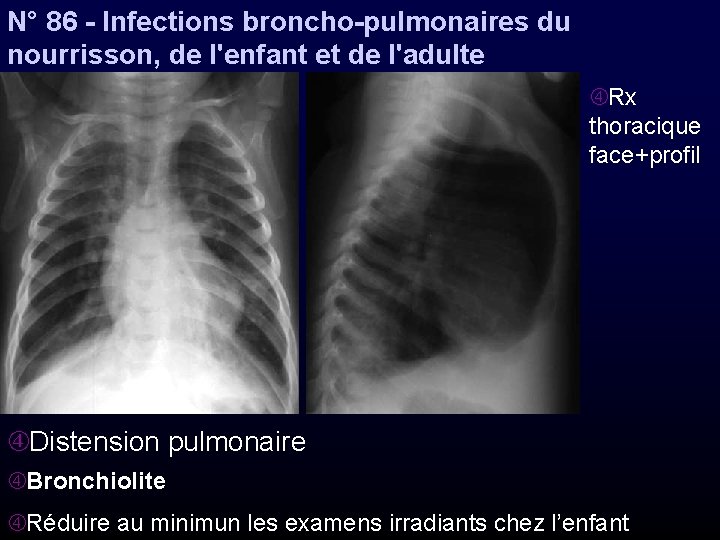 N° 86 - Infections broncho-pulmonaires du nourrisson, de l'enfant et de l'adulte Rx thoracique