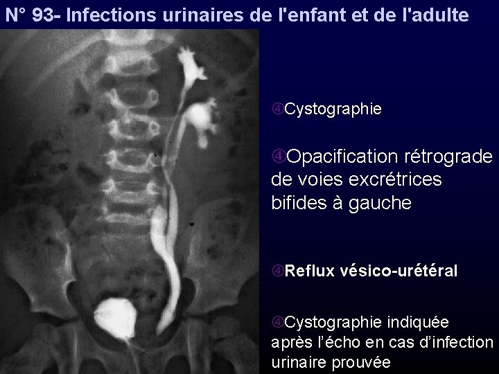 N° 93 - Infections urinaires de l'enfant et de l'adulte Cystographie Opacification rétrograde de