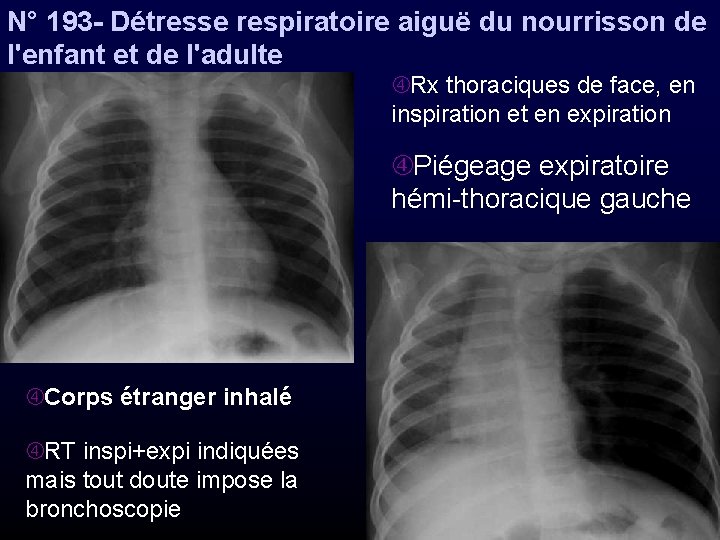 N° 193 - Détresse respiratoire aiguë du nourrisson de l'enfant et de l'adulte Rx