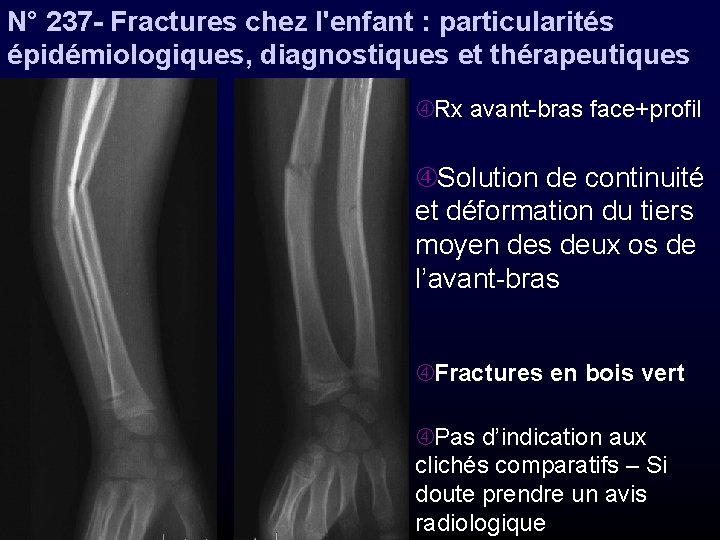 N° 237 - Fractures chez l'enfant : particularités épidémiologiques, diagnostiques et thérapeutiques Rx avant-bras