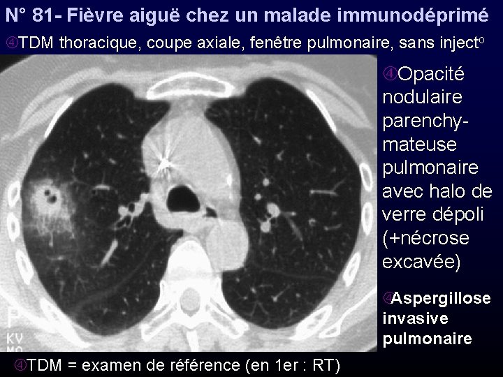 N° 81 - Fièvre aiguë chez un malade immunodéprimé TDM thoracique, coupe axiale, fenêtre