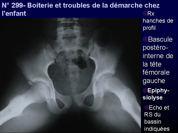 N° 299 - Boiterie et troubles de la démarche chez Rx l'enfant hanches de