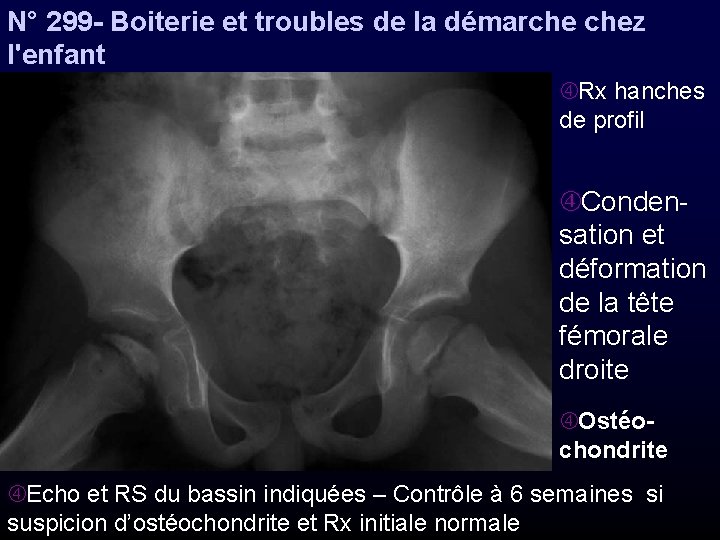 N° 299 - Boiterie et troubles de la démarche chez l'enfant Rx hanches de