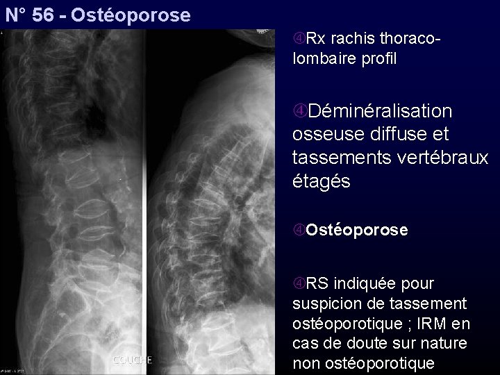 N° 56 - Ostéoporose Rx rachis thoracolombaire profil Déminéralisation osseuse diffuse et tassements vertébraux