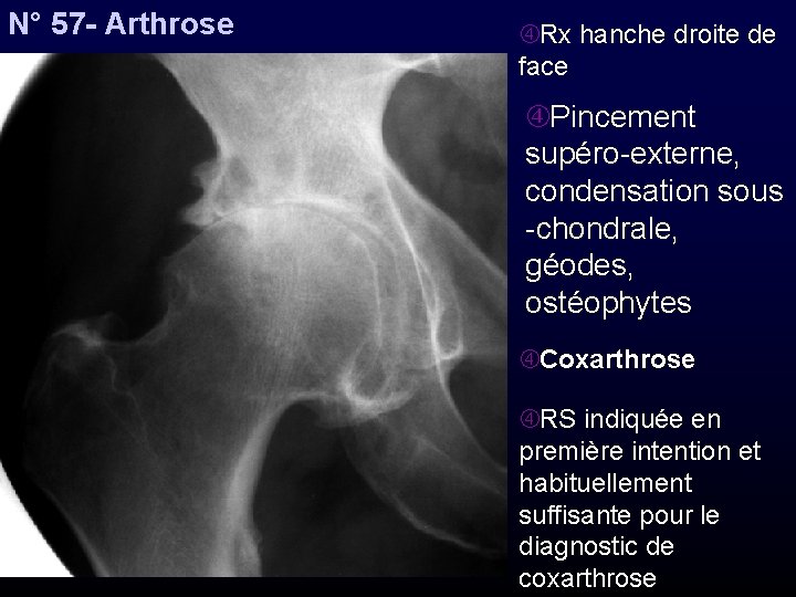 N° 57 - Arthrose Rx hanche droite de face Pincement supéro-externe, condensation sous -chondrale,