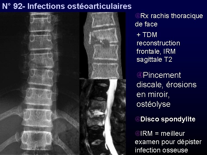 N° 92 - Infections ostéoarticulaires Rx rachis thoracique de face + TDM reconstruction frontale,