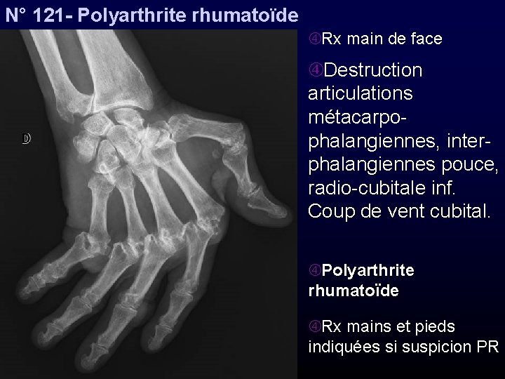 N° 121 - Polyarthrite rhumatoïde Rx main de face Destruction articulations métacarpophalangiennes, interphalangiennes pouce,