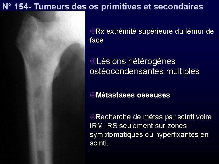 N° 154 - Tumeurs des os primitives et secondaires Rx extrémité supérieure du fémur