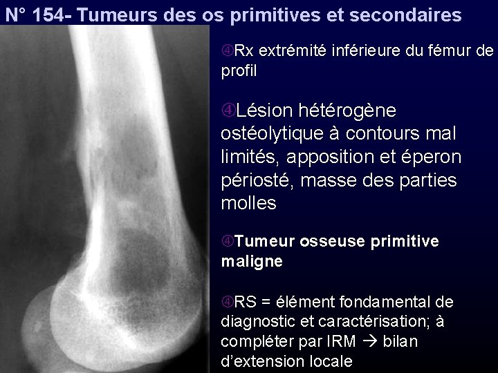 N° 154 - Tumeurs des os primitives et secondaires Rx extrémité inférieure du fémur