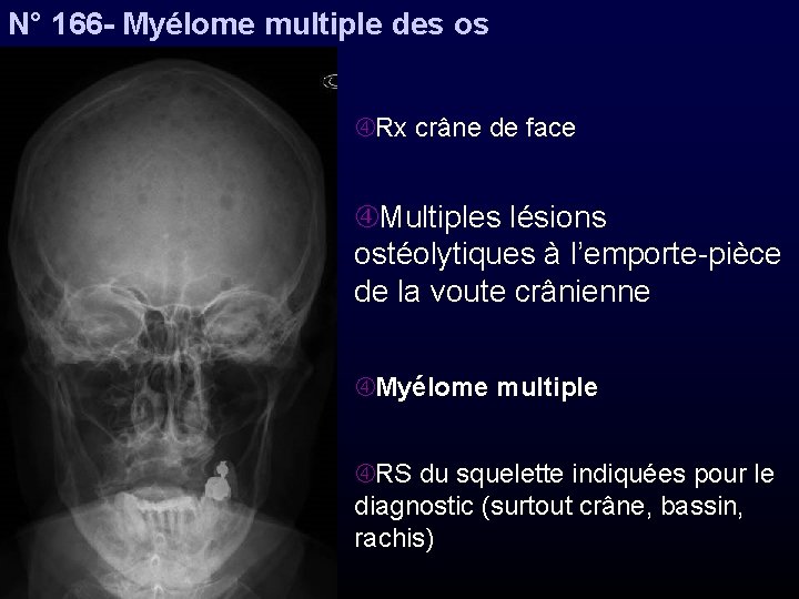 N° 166 - Myélome multiple des os Rx crâne de face Multiples lésions ostéolytiques