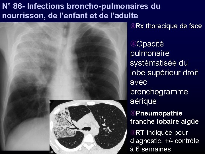 N° 86 - Infections broncho-pulmonaires du nourrisson, de l'enfant et de l'adulte Rx thoracique