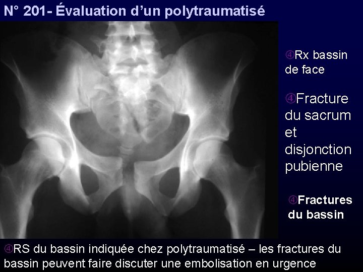 N° 201 - Évaluation d’un polytraumatisé Rx bassin de face Fracture du sacrum et